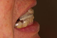 STEP2 歯科でのスリープスプリント製作：約5,000円＋（初診・再診料）

