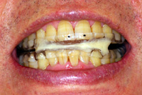 STEP2 歯科でのスリープスプリント製作：約5,000円＋（初診・再診料）
